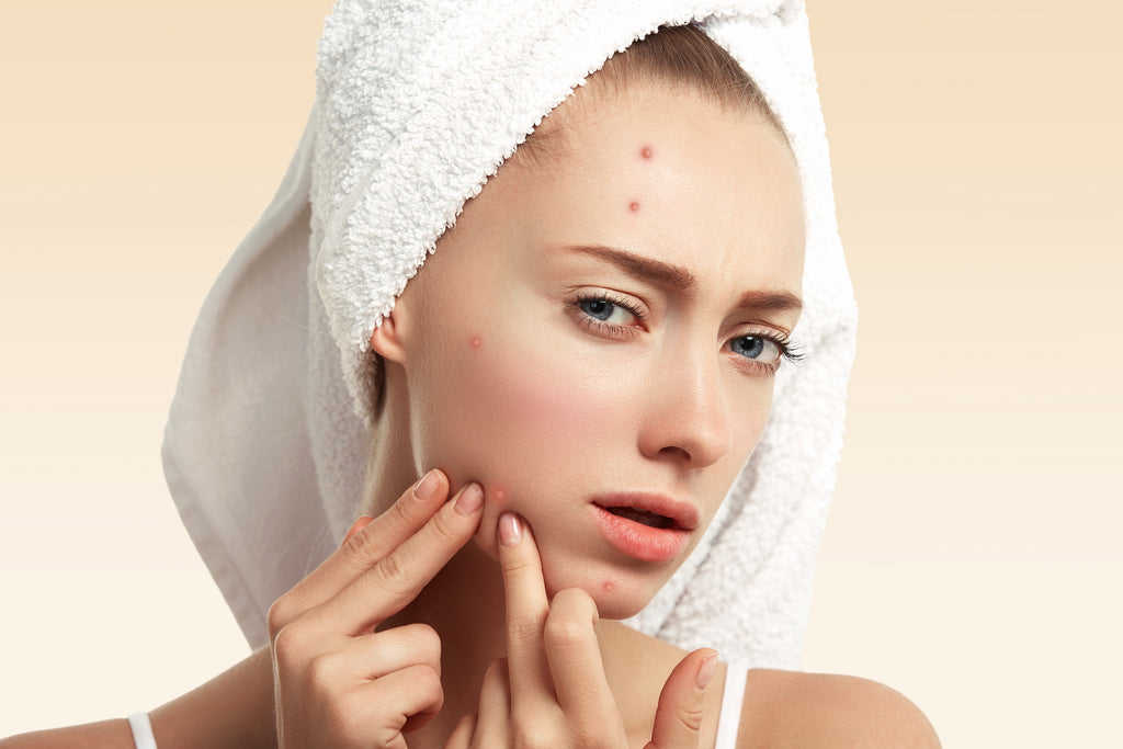How to Clear Pimples on Face?