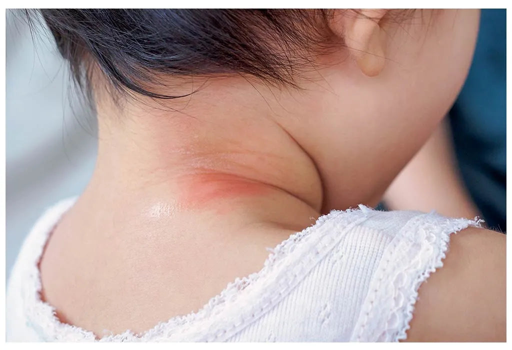 Heat Rashes & Prickly Heat: How to Keep Your Baby’s Skin Cool & Comfortable