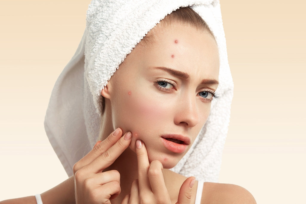 How to Clear Pimples on Face? - Doctor Towels