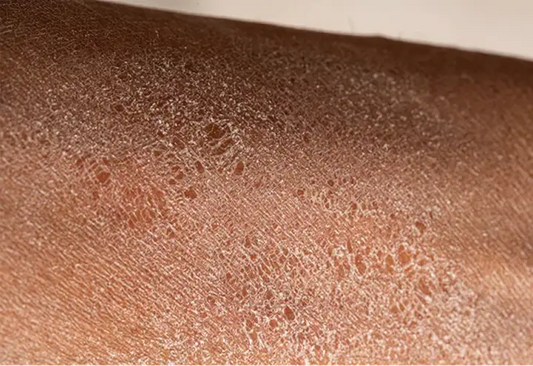 Eczema Flare-Ups & Dry Patches? Your Towel Might Be Making It Worse!