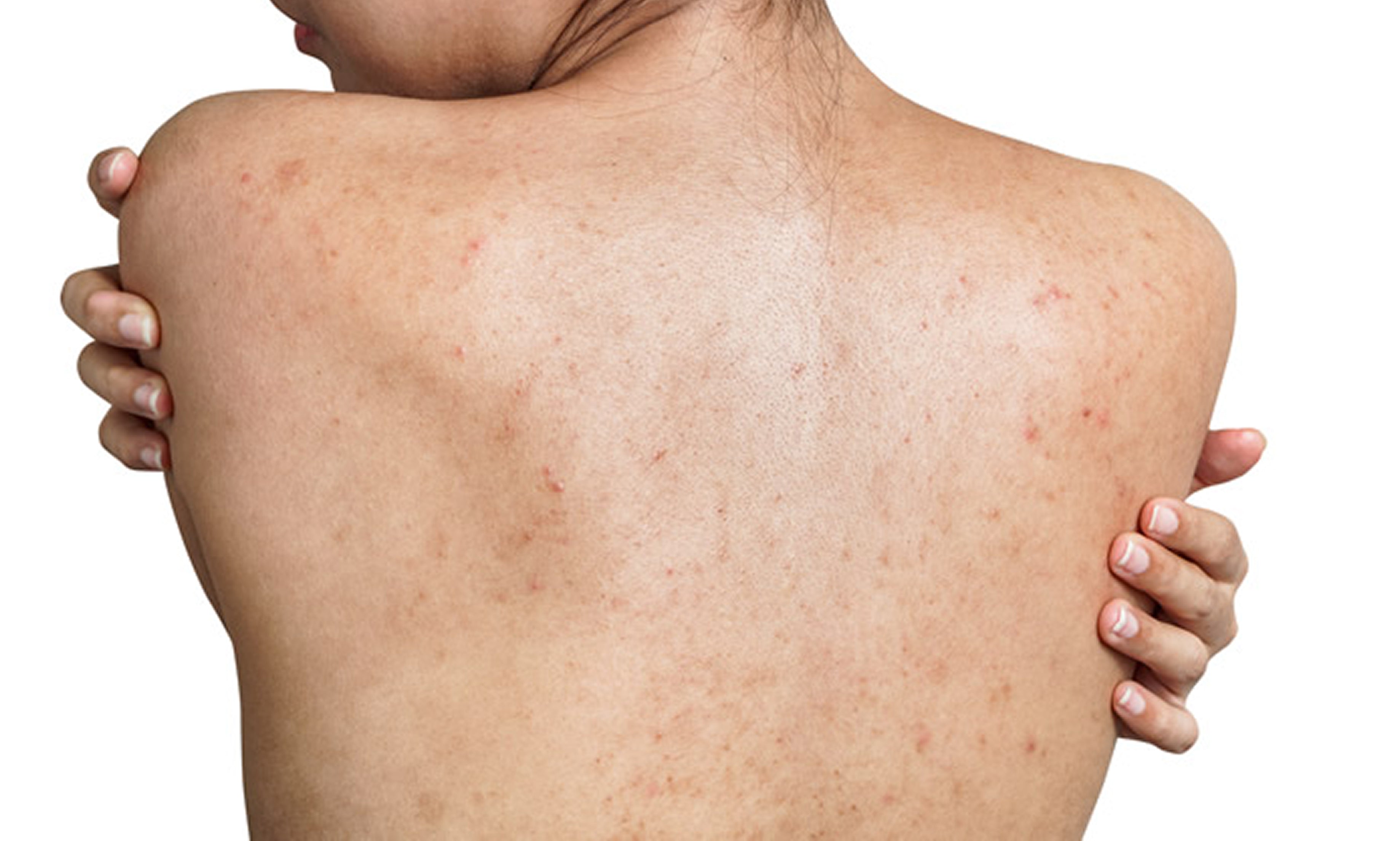 Struggling with Stubborn Back Acne?